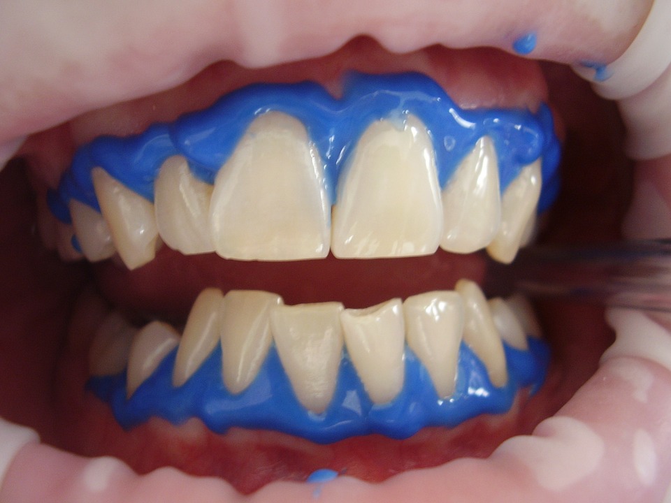Professional Ways of Teeth Whitening and Procedures - Mplsdental