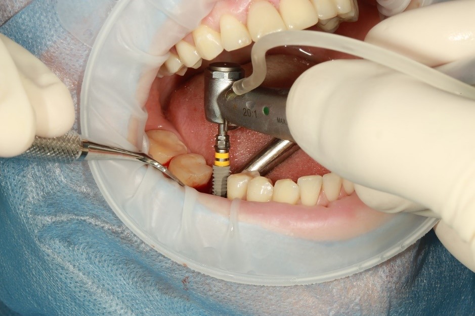 Dental Implant Services 