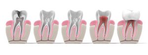 ROOT CANAL TREATMENT INFECTIONS