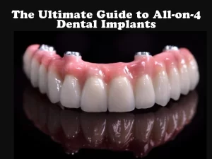 What are All-on-4 Dental Implants