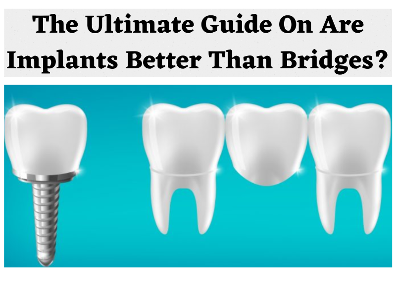 Are Implants Better Than Bridges