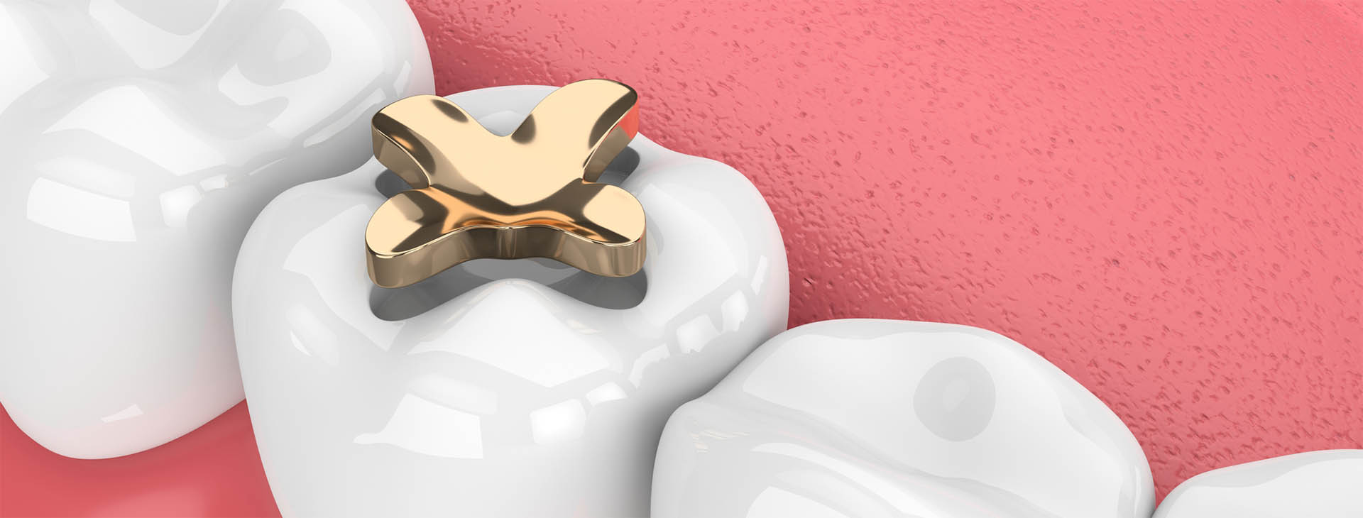 Dental Sealants Minneapolis Dental